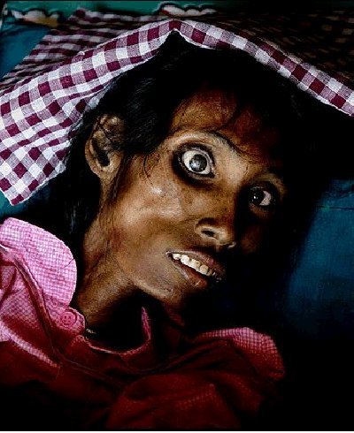 The AIDS virus spreads through the sexual organs.